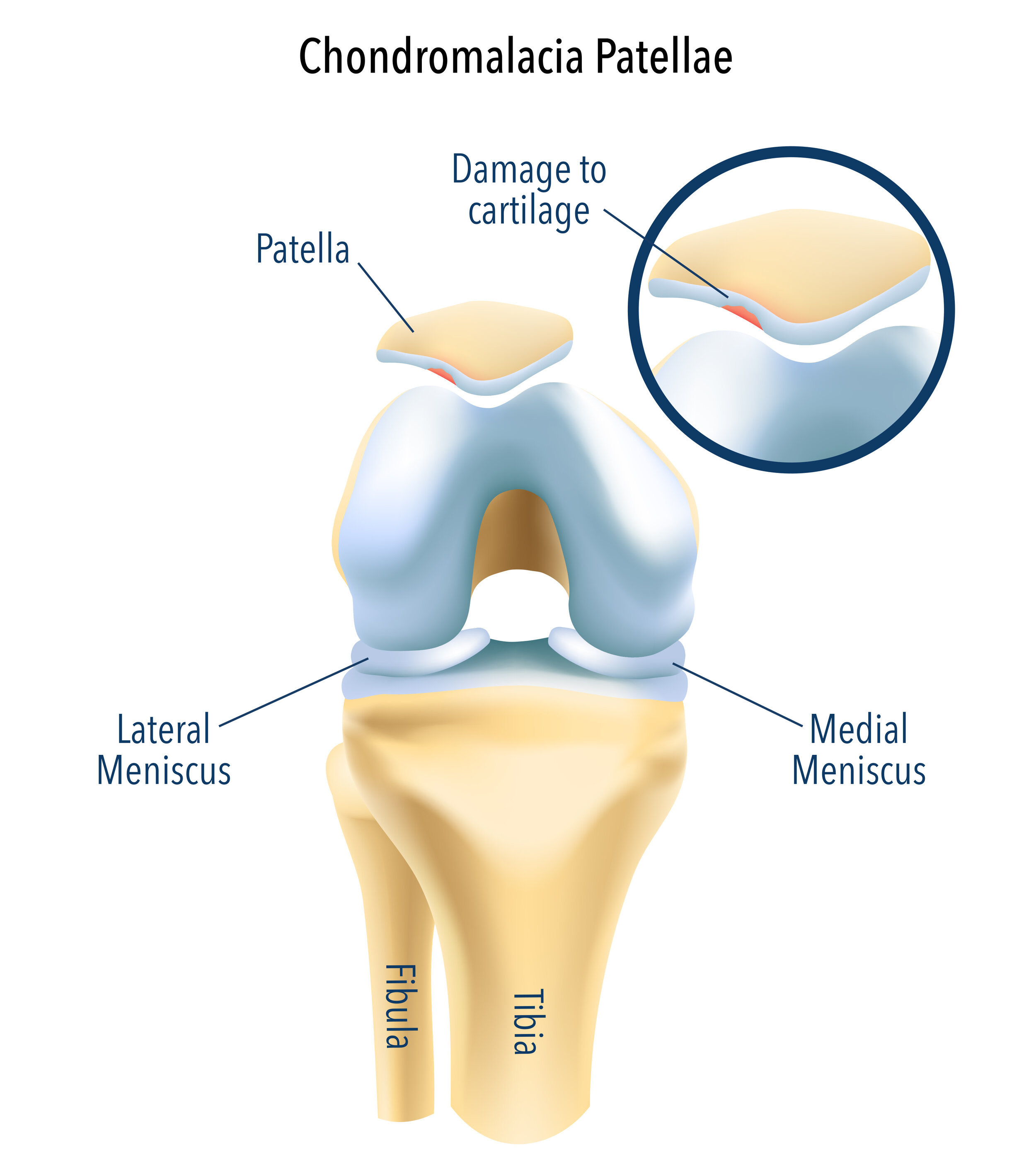 Chondromalacia Patellae Treatment by Dr. Jigar Desai