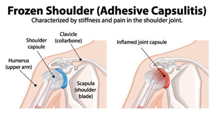 Frozen Shoulder Treatment