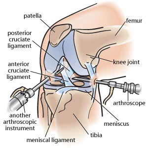Knee Arthroscopy Consultation with Dr. Jigar Desai