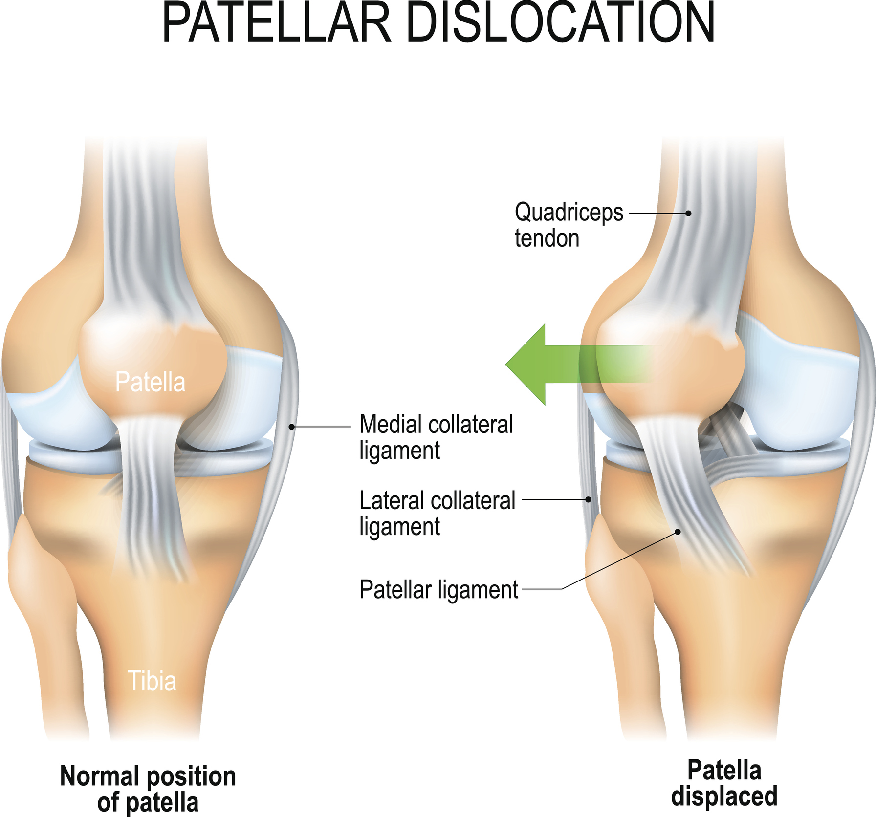 Knee Instability Treatment