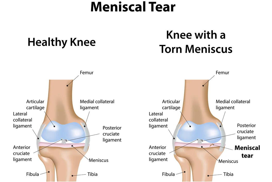 Meniscus Injury Treatment