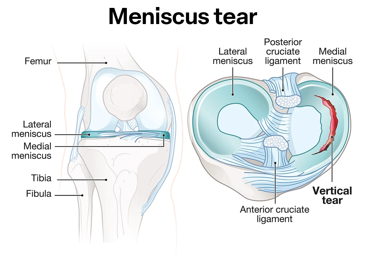 Meniscus Injury Treatment by Dr. Jigar Desai