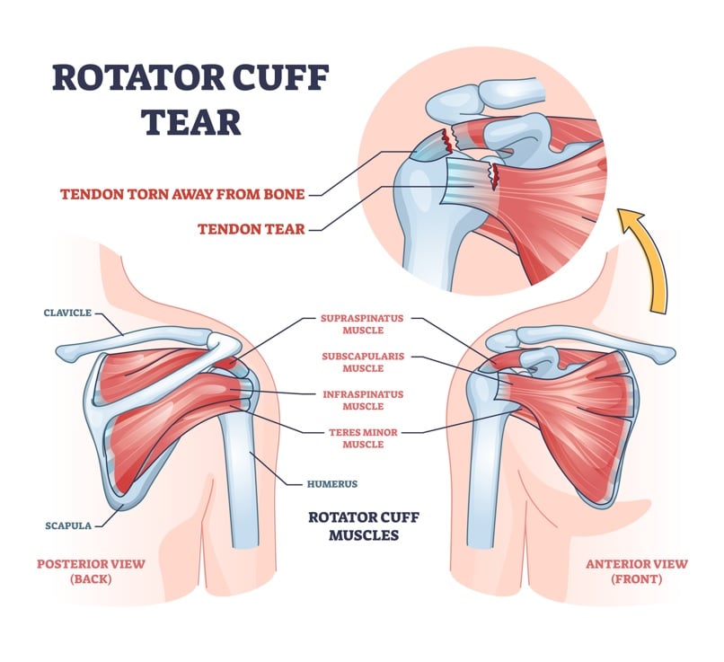 Rotator Cuff Tear Treatment by Dr. Jigar Desai