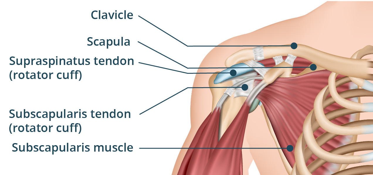 Rotator Cuff Tear Treatment by Dr. Jigar Desai