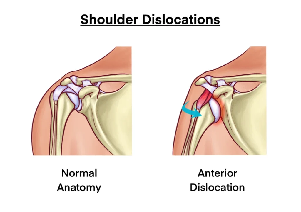 Recurrent Shoulder Dislocation Treatment by Dr. Jigar Desai