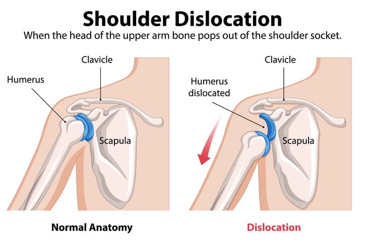 Recurrent Shoulder Dislocation Treatment